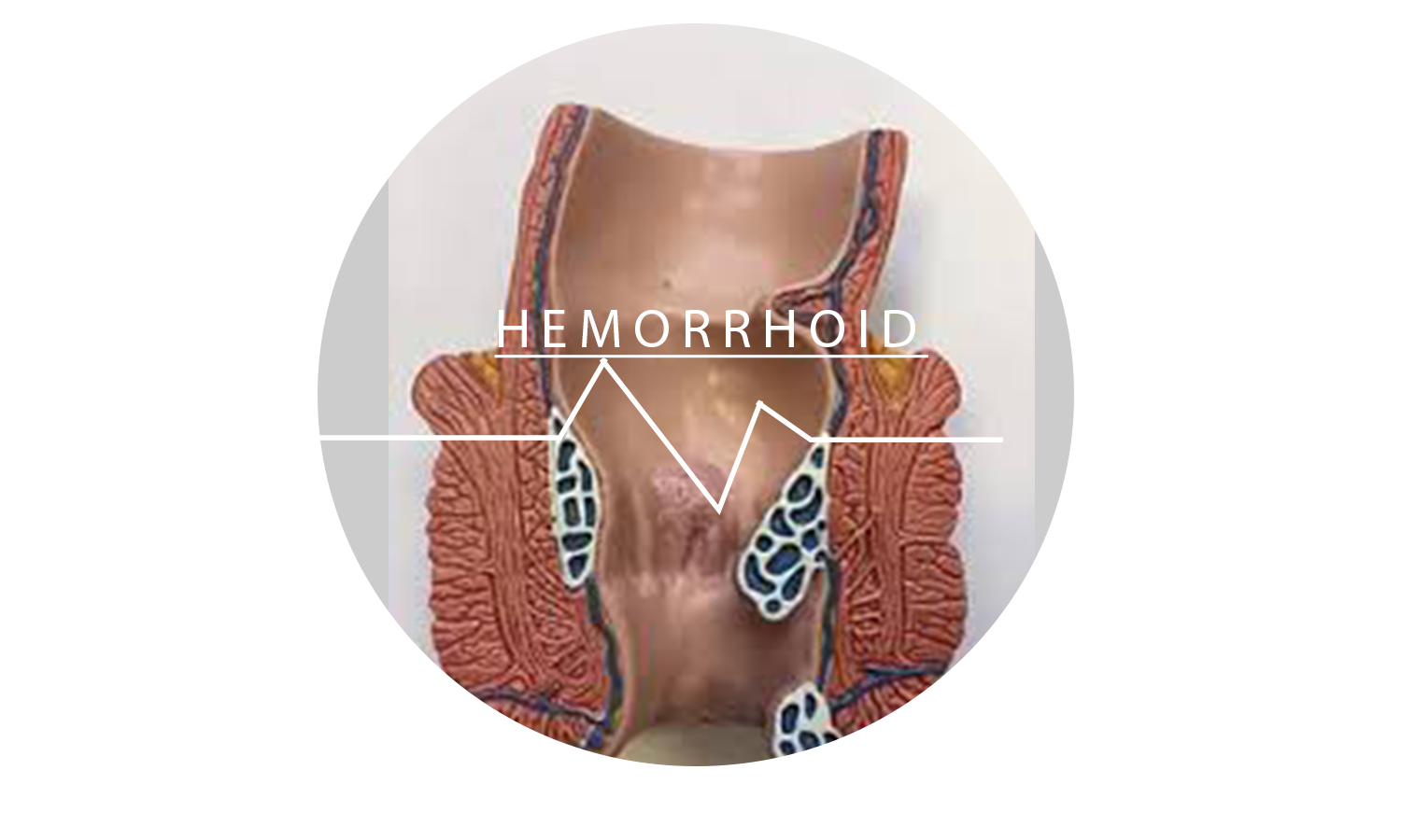 HEMORRHOID TREATMENT PACK