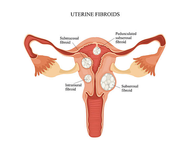 Female reproductive system - uterine fibroid. Human anatomy